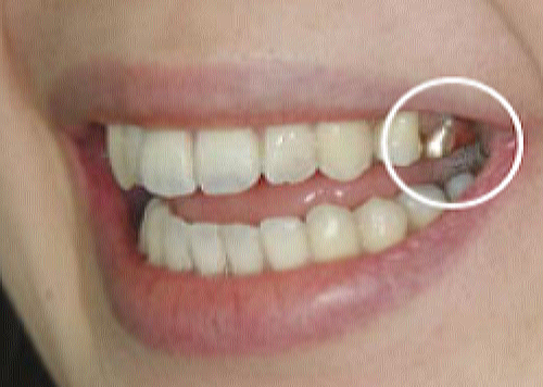 銀歯の入った歯